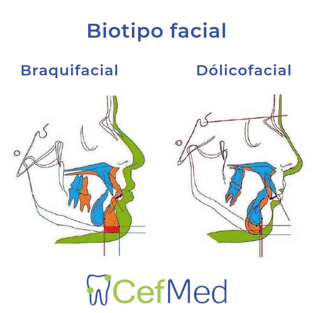 Biotipo Facial entre ellos se mencionan Braquifacial, Mesofacial Y Dólicofacial