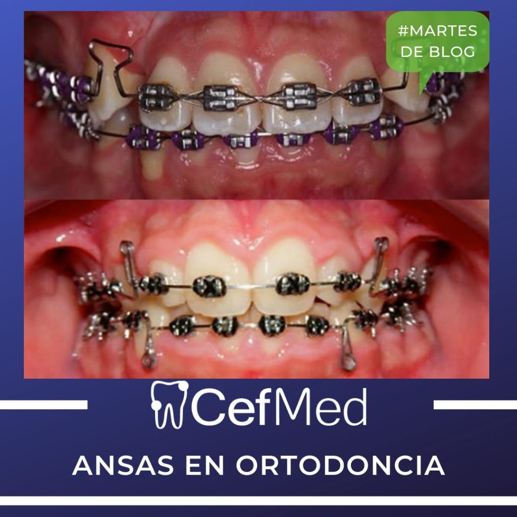 ansas en ortodoncia