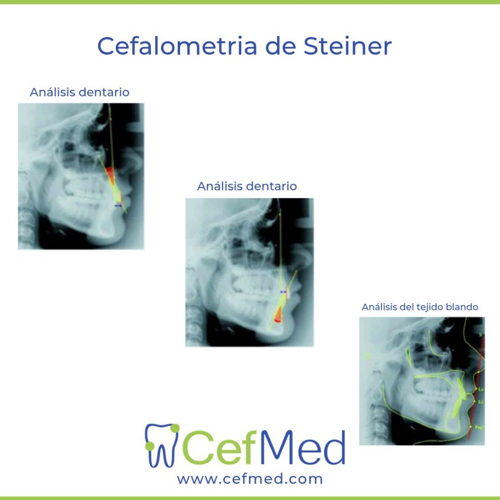 cefalometria de steiner