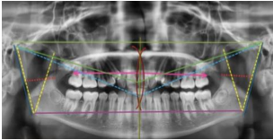 Cefalograma en radiografía panorámica - CefMed - Software Cefalometría