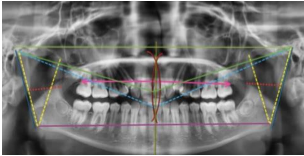 Usos de la ortopantomografía en Cefalometría